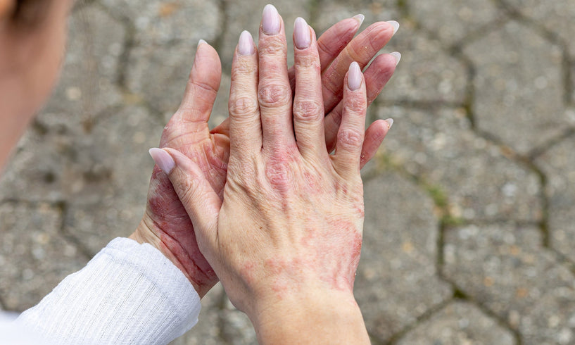 Hängen Stress und Ekzeme zusammen? image