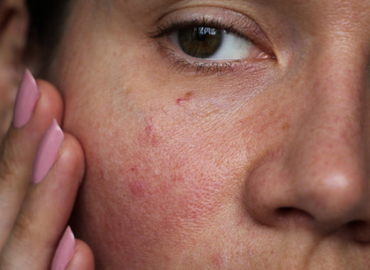 Anti-redness skin care: serum & moisturiser image